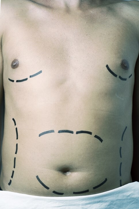 Gynecomastia Correction