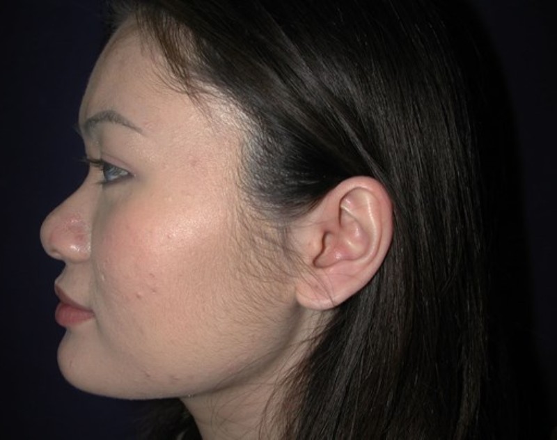 before nasal augmentation side view female patient case 883