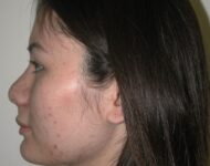 after nasal augmentation side view female patient case 883