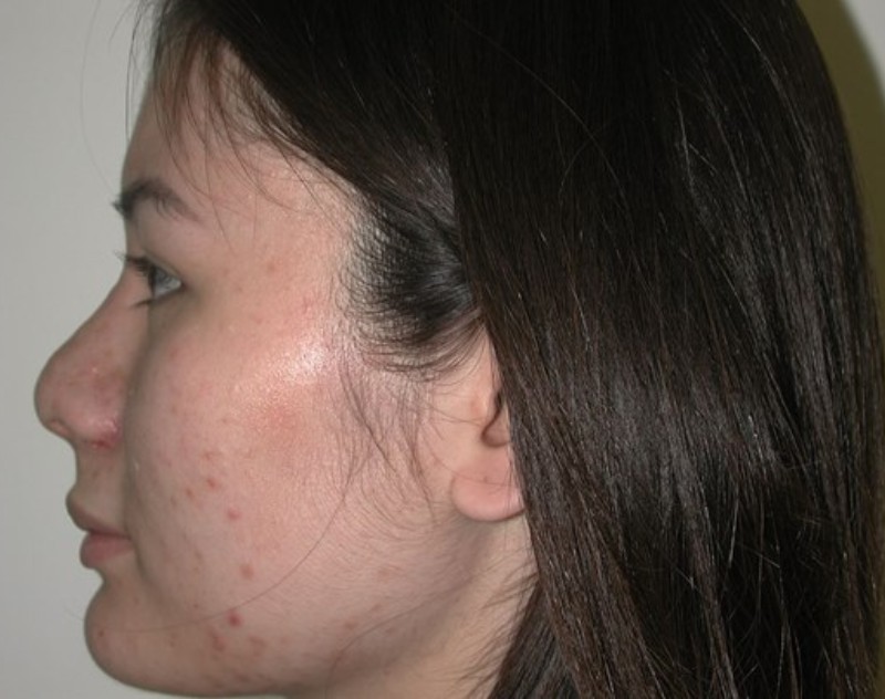 after nasal augmentation side view female patient case 883