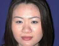 before nasal augmentation front view female patient case 883