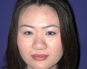 before nasal augmentation front view female patient case 883