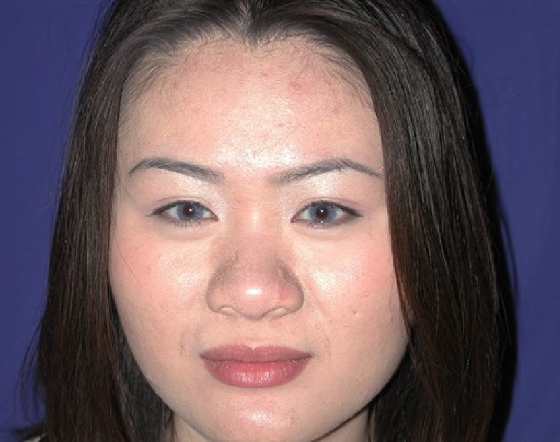before nasal augmentation front view female patient case 883