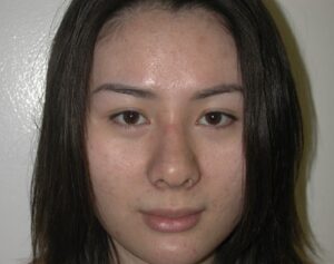 after nasal augmentation front view female patient case 883
