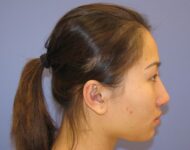 before nasal augmentation right side view female patient case 870
