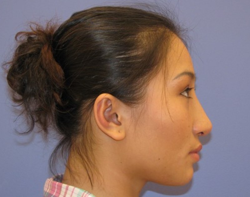 after nasal augmentation right side view female patient case 870