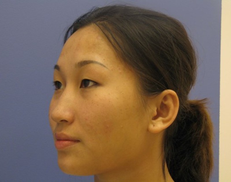 before nasal augmentation left angle view female patient case 870