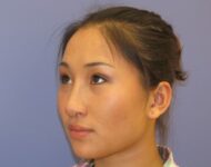 after nasal augmentation left angle view female patient case 870