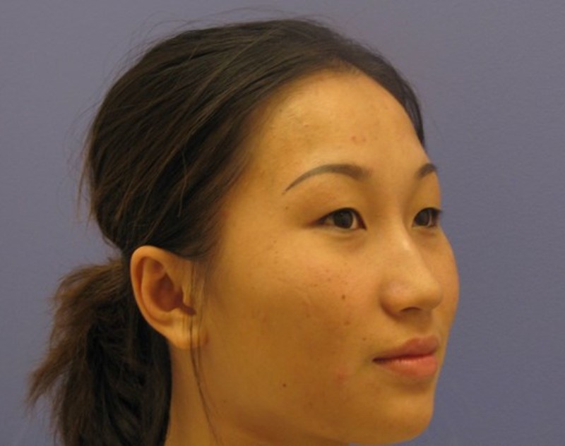 before nasal augmentation right angle view female patient case 870