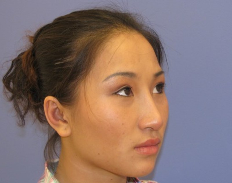 after nasal augmentation right angle view female patient case 870