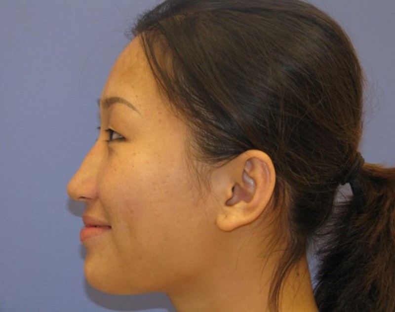 before nasal augmentation left side view female patient case 870