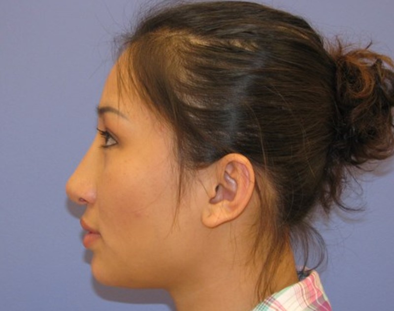 after nasal augmentation left side view female patient case 870