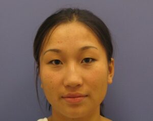 before nasal augmentation front view female patient case 870