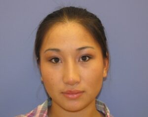 after nasal augmentation front view female patient case 870