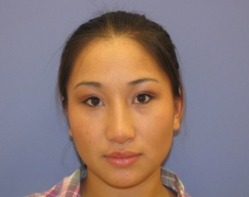 after nasal augmentation front view female patient case 870
