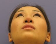 before nasal augmentation bottom view female patient case 870