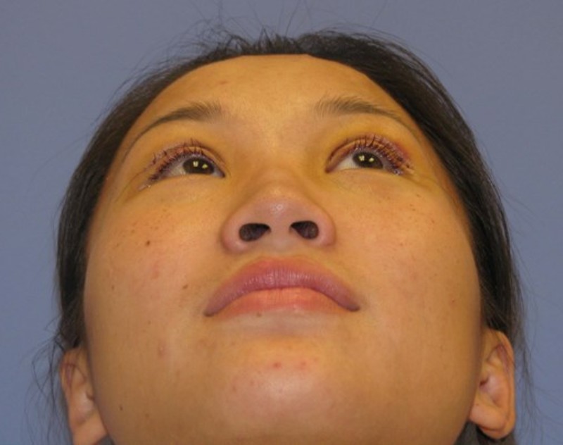 after nasal augmentation bottom view female patient case 870