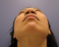 before nasal augmentation bottom view female patient case 859