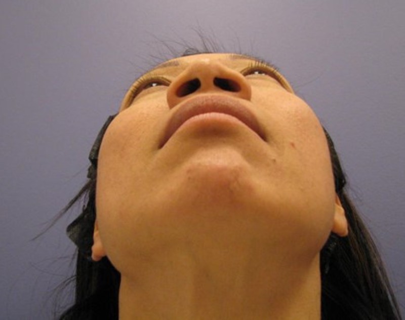 before nasal augmentation bottom view female patient case 859