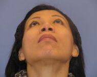 after nasal augmentation bottom view female patient case 859