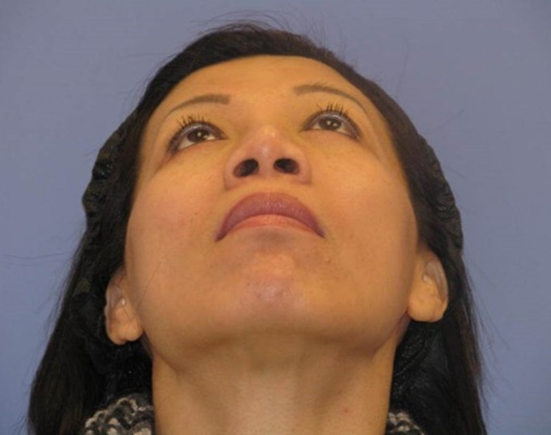after nasal augmentation bottom view female patient case 859