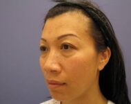 before nasal augmentation left angle view female patient case 859