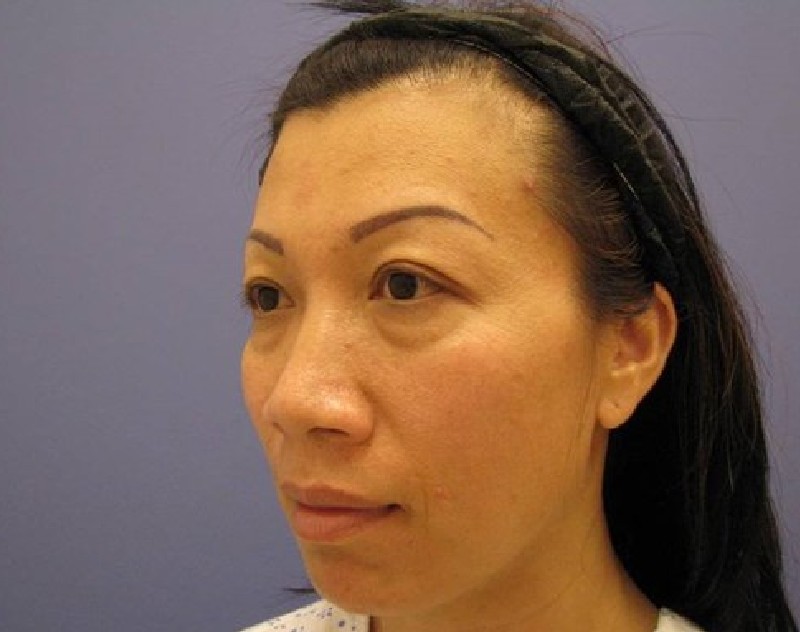 before nasal augmentation left angle view female patient case 859