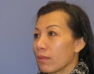 after nasal augmentation left angle view female patient case 859