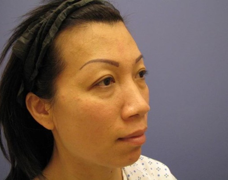 before nasal augmentation right angle view female patient case 859