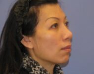 after nasal augmentation right angle view female patient case 859