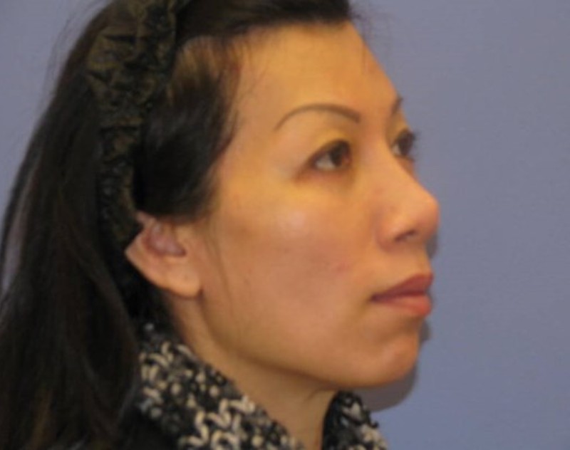 after nasal augmentation right angle view female patient case 859