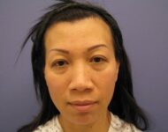 before nasal augmentation front view female patient case 859