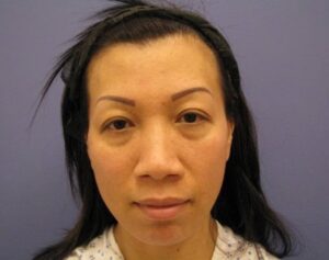 before nasal augmentation front view female patient case 859