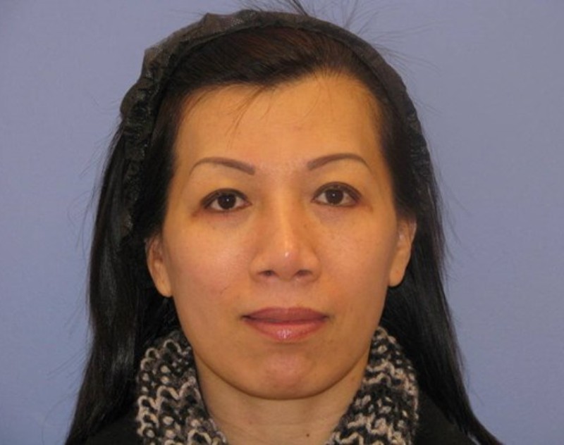 after nasal augmentation front view female patient case 859