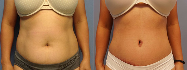 tummy tuck before and after