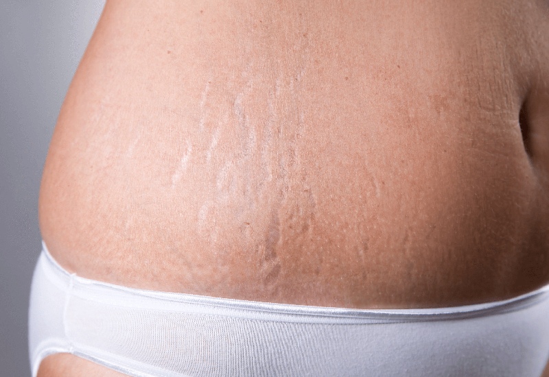 Can the Appearance of Stretch Marks be Improved Through a Mommy Makeover?