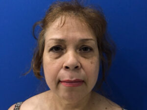 before asian facelift front view female patient case 8930