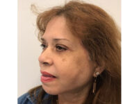 after asian facelift left angle view female patient case 8930