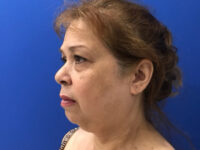 before asian facelift left angle view female patient case 8930