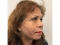 after asian facelift right side view female patient case 8930