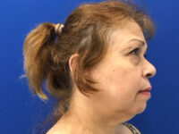 before asian facelift right side view female patient case 8930