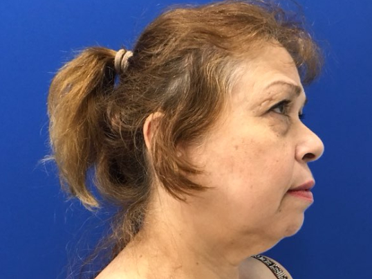 before asian facelift right side view female patient case 8930
