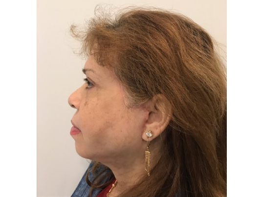 after asian facelift left side view female patient case 8930
