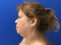 before asian facelift left side view female patient case 8930