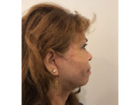 after asian facelift right side view female patient case 8930