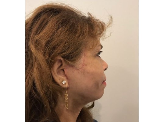 after asian facelift right side view female patient case 8930