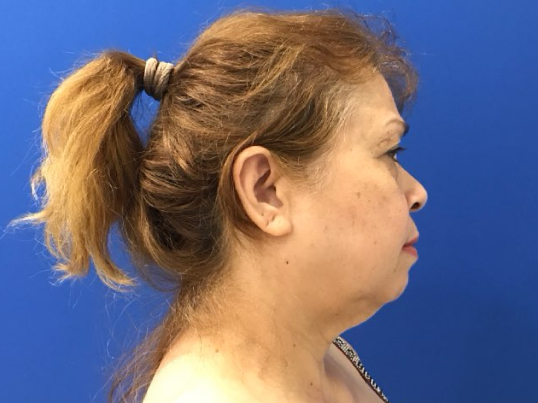 before asian facelift right side view female patient case 8930