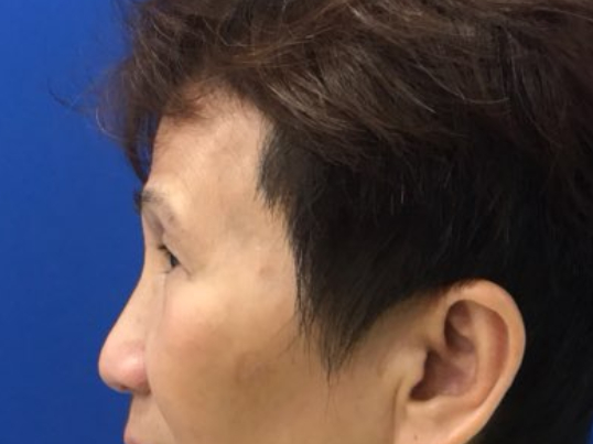before brow lift left side view female patient case 8911