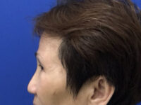 after brow lift left side view female patient case 8911