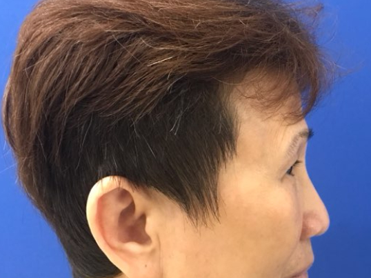 before brow lift right side view female patient case 8911